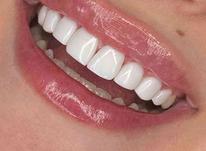 کامپوزیت دندان طرح لبخندی در شیپور-عکس کوچک