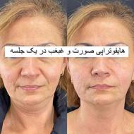 جشنواره بهاری هایفو رفع چروک و لک صورت «فقط 30 دقیقه»