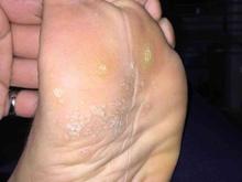 درمان تضمینی میخچه پا در شیپور