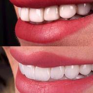 کامپوزیت دندان/دندانپزشکی