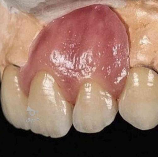 دندانسازی _ دندان مصنوعی _ پروتز متحرک _ دندانپزشکی