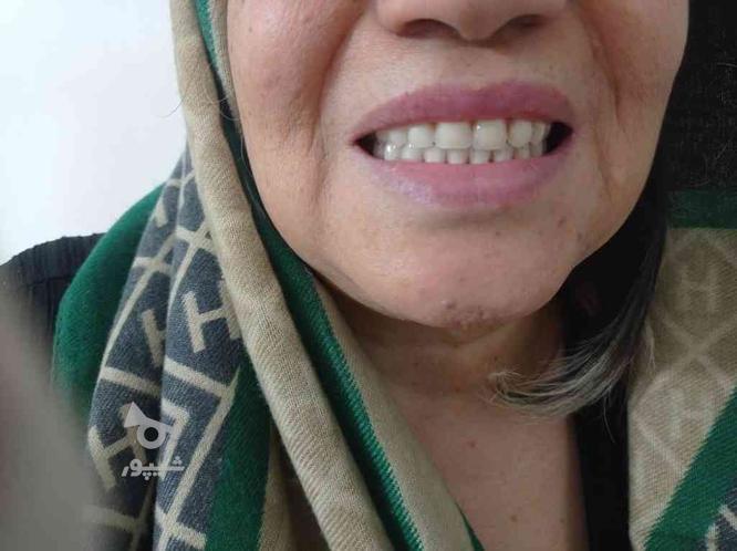 دندانسازی اسپادانا ظاهری طبیعی
