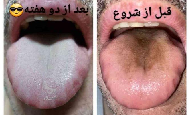 تشخیص بیماری از روی زبان