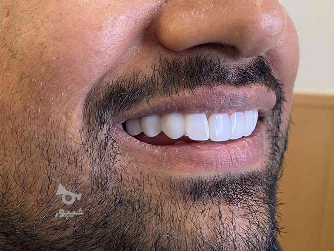 دندانپزشکی عصب کشی کامپوزیت ایمپلنت اطفال دندانسازی
