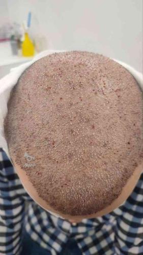 کاشت مو به روش fitمیکرو گرافت