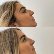 لیفت بینی با نخ در ساری