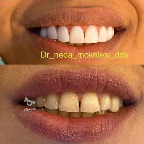 دندانپزشکی دندانساز عصب کشی کامپوزیت ونیر اطفال بلیچینگ