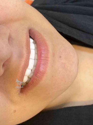 دندانپزشکی دندانساز عصب کشی کامپوزیت ونیر اطفال بلیچینگ