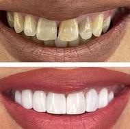 دندانپزشکی کامپوزیت لمینیت ترمیم دندان( اقساطی)
