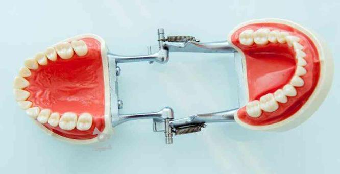 دست دندان کامل و تکه ای ( دندانسازی ) رفع لقی دندان
