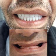 دندانسازی / دندان مصنوعی