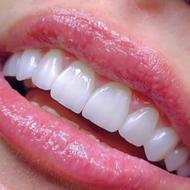 دندانپزشکی زیبایی لمینیت کامپوزیت