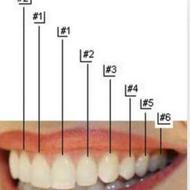 عصبکشی دندان 6(با کم ترین قیمت)