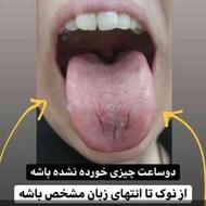 مشاوره رایگان تشخیص بیماری از روی زبان