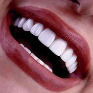 خدمات دندانپزشکی زیبایی کامپوزیت