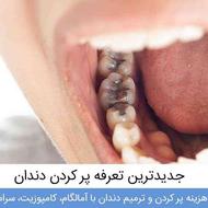 پرکردن دندان ها با قیمت 280 دولتی کوت عبدالله 