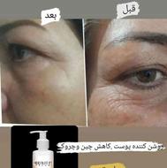 درمان انواع لک های صورت ومشکلات پوستی