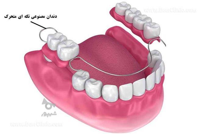 دندانسازی بختیاری (ساخت دست دندان بابیمه) دندان مصنوعی