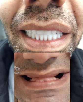 ...دندانسازی..دندان مصنوعی... در گروه خرید و فروش خدمات و کسب و کار در تهران در شیپور-عکس1