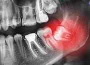 مرکز تخصصی جراحی دندان عقل و‌جراحی دندان نهفته
