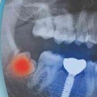 جراحی ایمپلنت کره ایی اصل و جراحی دندان عقل