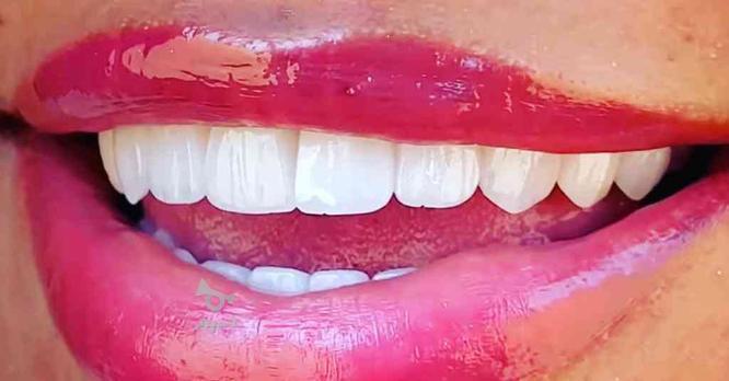 کوره دندانسازی و دندانپزشکی