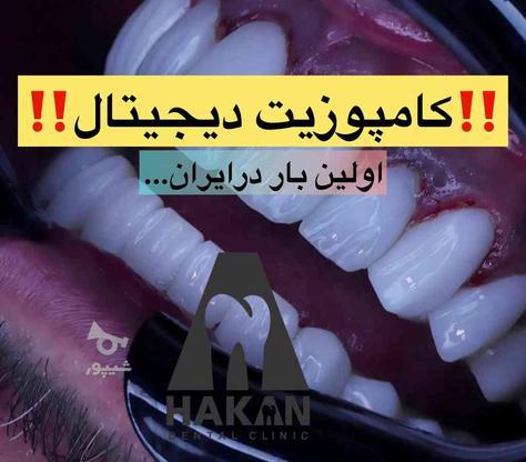 کامپوزیت دندان دیجیتال / خدمات دندانپزشکی روکش لمینت در گروه خرید و فروش خدمات و کسب و کار در تهران در شیپور-عکس1