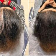 درمان ریزش مو مزوتراپی، پی ارپی، کربوکسی تراپی