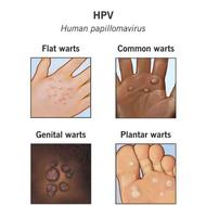 درمان بیماری زگیل تناسلی (HPV)