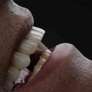ایمپلنت دندان از دم قسط با اقساط 24 ماهه