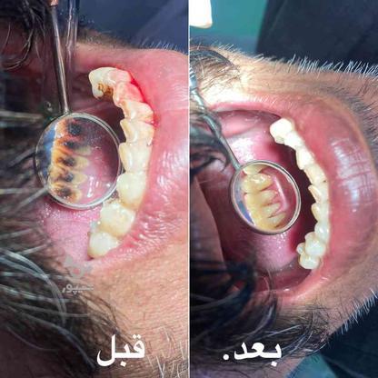 جرم گیری و سفیدی دندان با کمترین قیمت در بیرجند در گروه خرید و فروش خدمات و کسب و کار در خراسان جنوبی در شیپور-عکس1