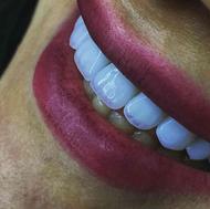 دندانپزشکی زیبایی(کامپوزیت و لمینت) و ایمپلنت
