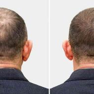 درمان ریزش و کاهش موی سر کاشت مو مزوتراپی و hairfiller و prp