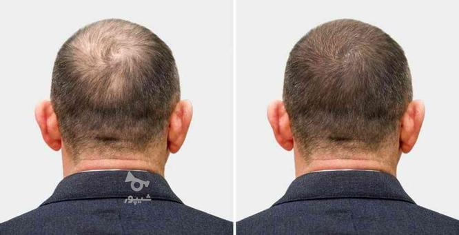 درمان ریزش و کاهش موی سر کاشت مو مزوتراپی و hairfiller و prp در گروه خرید و فروش خدمات و کسب و کار در تهران در شیپور-عکس1