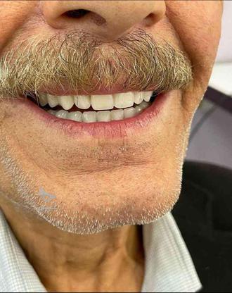 دندانسازی خیریه طرح لمینت در گروه خرید و فروش خدمات و کسب و کار در خراسان رضوی در شیپور-عکس1