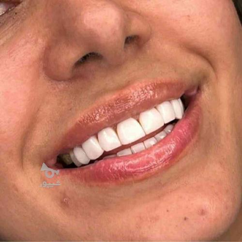 کامپوزیت دندانپزشکی و دندانسازی