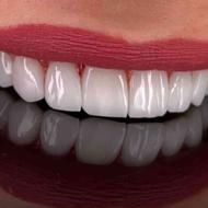 خدمات دندانپزشکی کامپوزیت.ایمپلنت ودندان مصنوعی