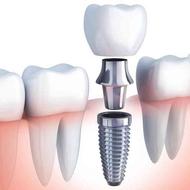 ایمپلنت دندان (دندانپزشکی) بدون درد