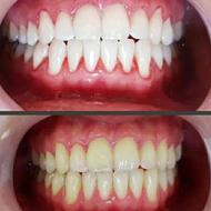 بلیچینگ سفید کردن دندان