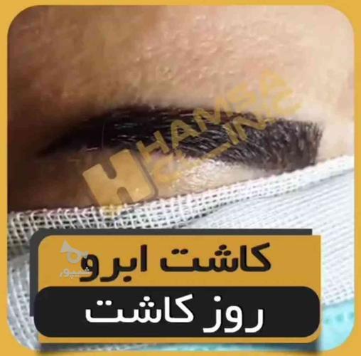 کاشت، مو، ریش، ابرو