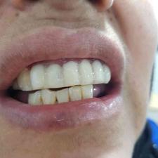 کشیدن دندان و دندان عقل