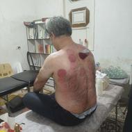 حجامت زالو فصد خون زدن زردی دیسک و سیاتیک دررفتگی