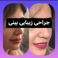 جراحی زیبایی بینی