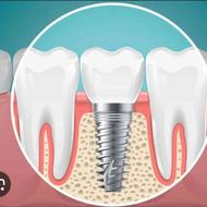 ایمپلنت و لمینیت اا