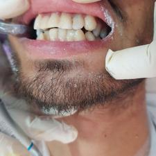 زیبایی دندانها در یک جلسه