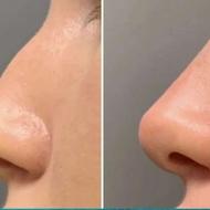 مزوتراپی مزونیدلینگ ژل لب کانتورینگ زاویه بوتاکس فیشیال