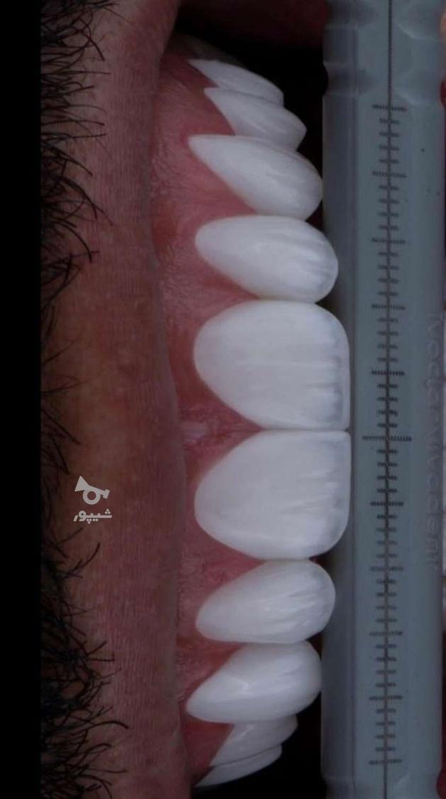 کاشت دندان(ایمپلنت)/جرم گیری دندون/پرکردن دندان/بروساژ