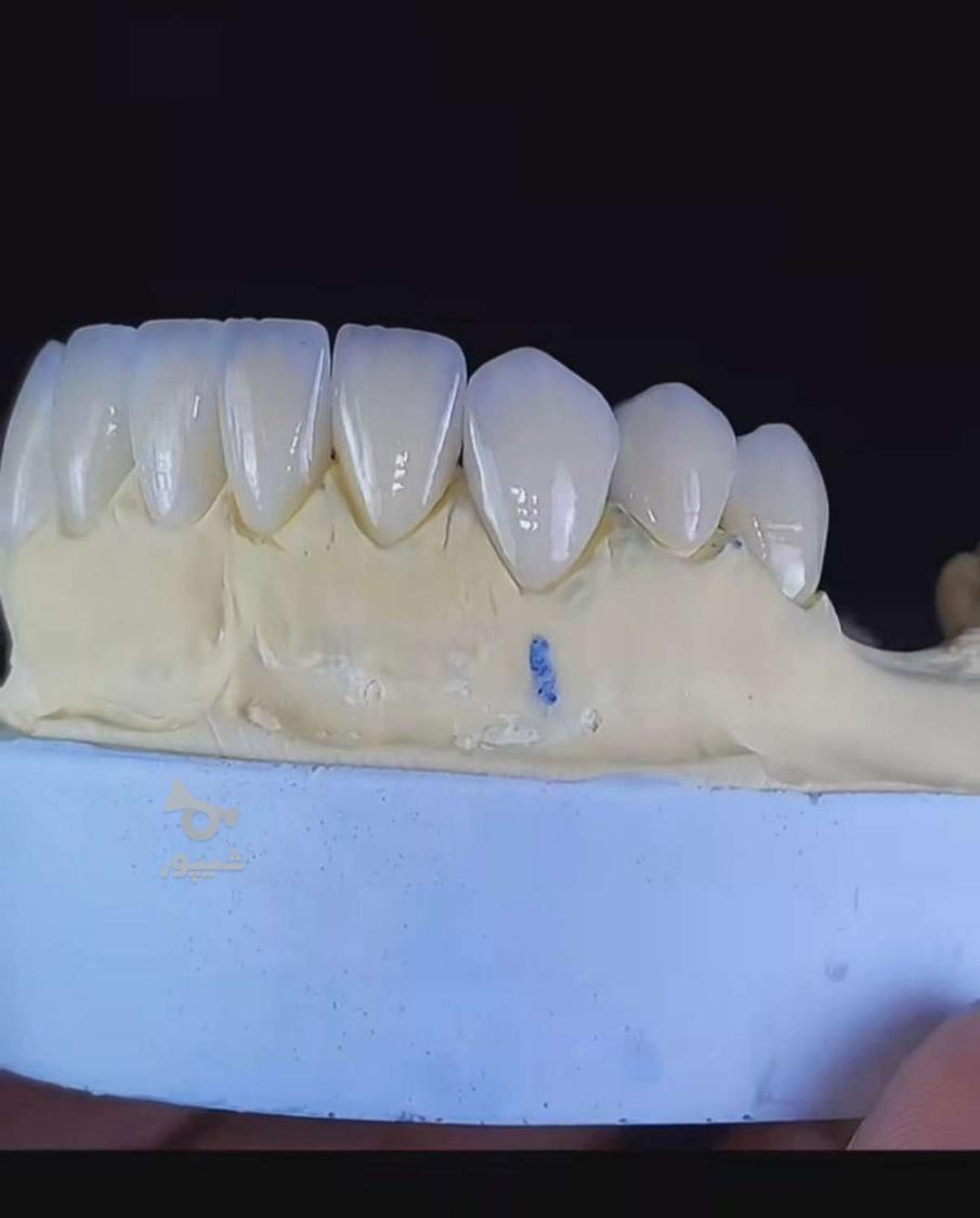 کاشت دندان(ایمپلنت)/جرم گیری دندون/پرکردن دندان/بروساژ