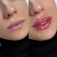 ژل بوتاکس مزوتراپی جوانسازی