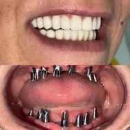 ایمپلنت و اوردنچر هر واحد 5500
